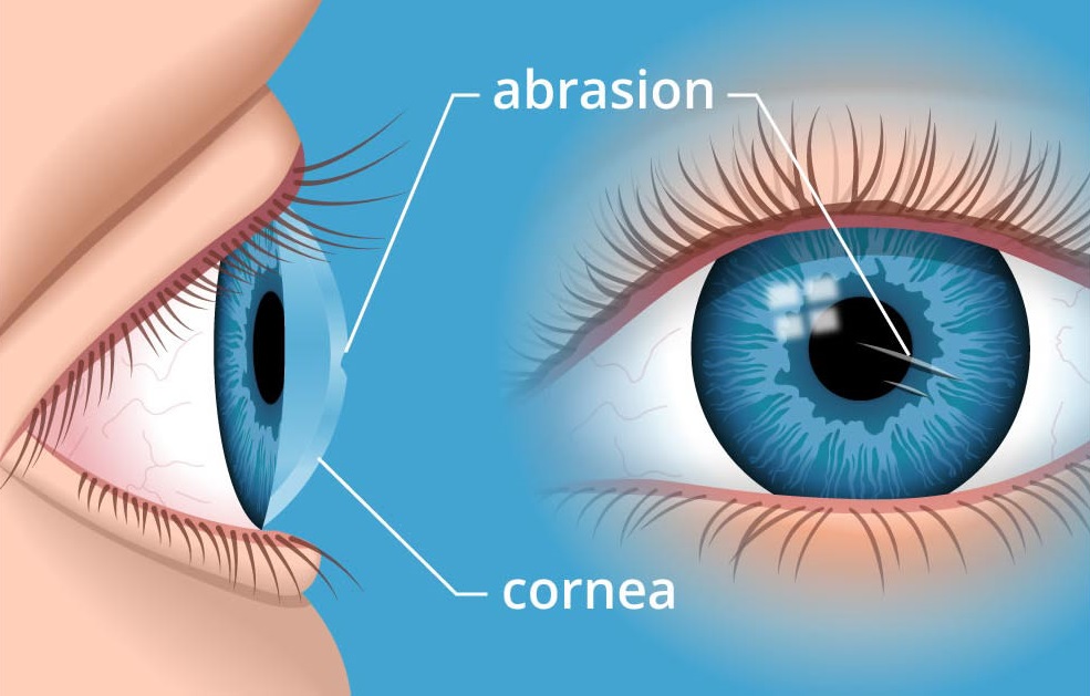 Cornea Specialist in Bangladesh