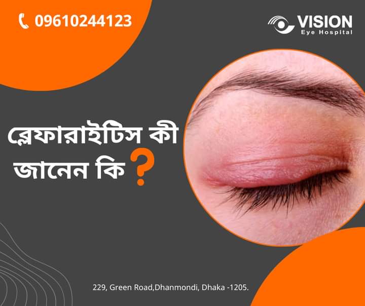 ব্লেফারাইটিস কী জানেন কি??