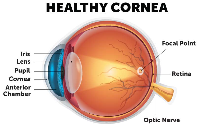 Cornea Transplant | Things To Know About Cornea Transplantation