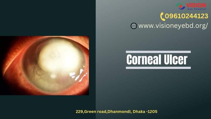 Corneal Ulcer.