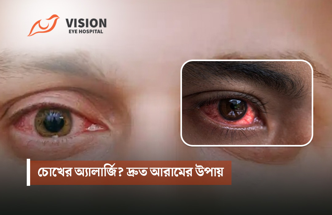 চোখের অ্যালার্জি? দ্রুত আরামের উপায়