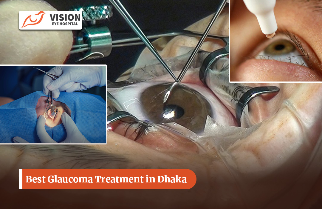 Best Glaucoma Treatment in Dhaka