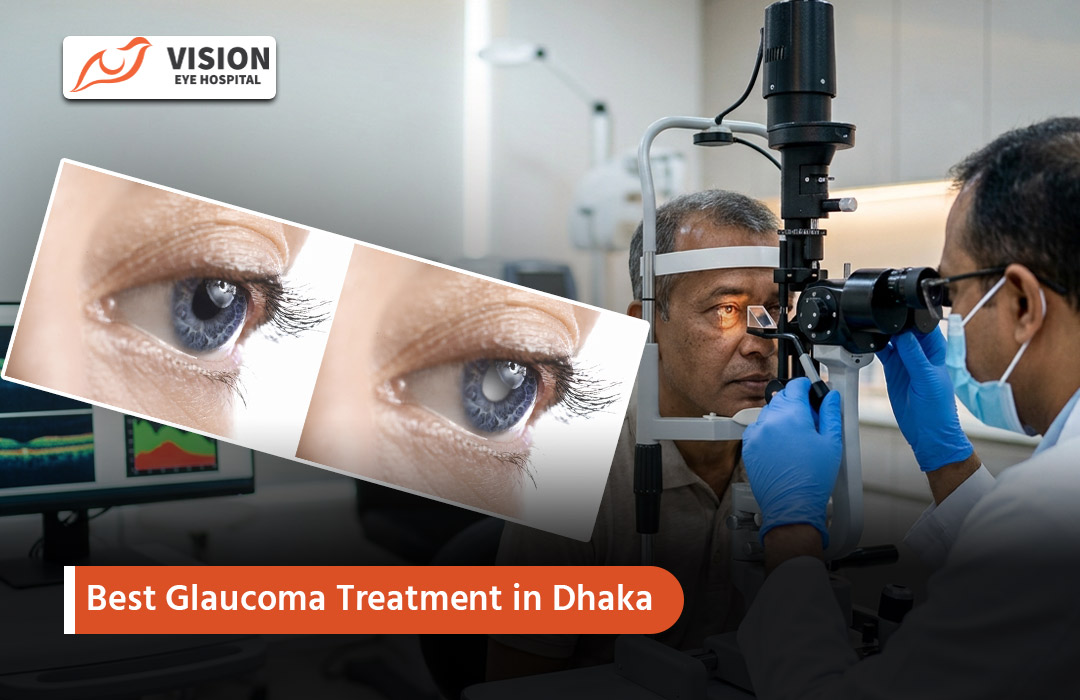 Best Glaucoma Treatment in Dhaka
